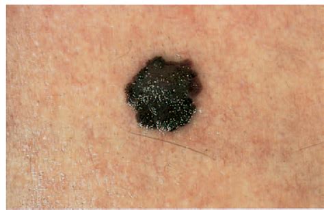 black spot on skin melanoma
